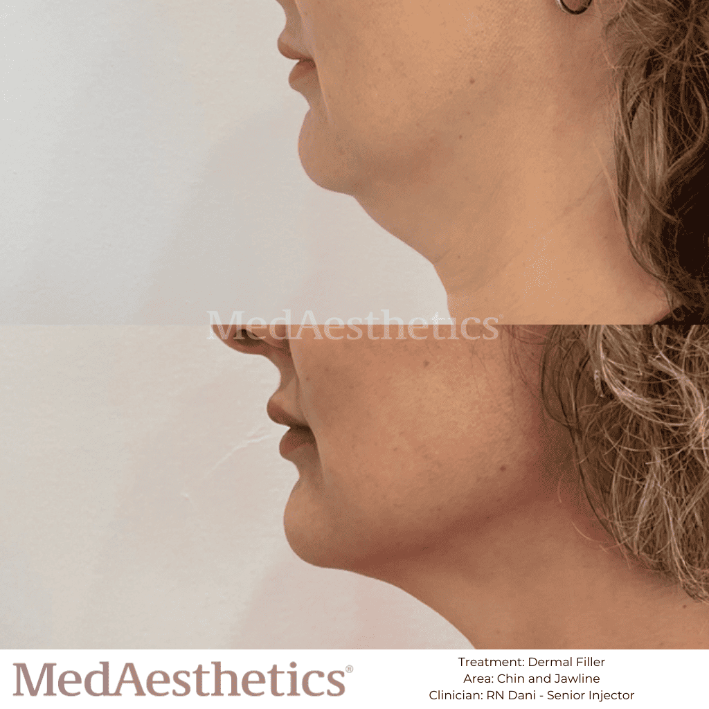 Dermal Filler Chin & Jawline Before & After MedAesthetics Perth