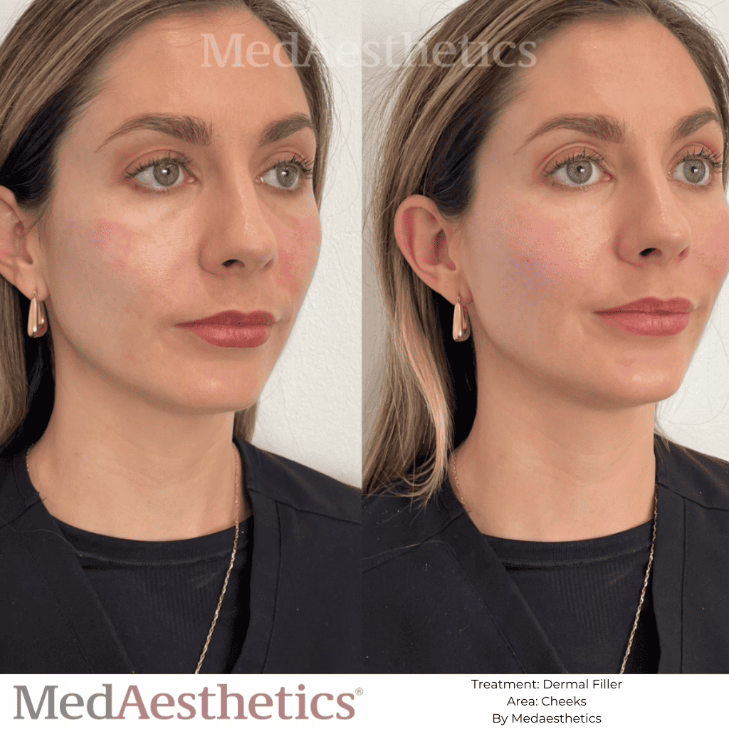 how long do dermal fillers last