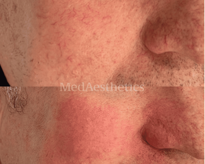 Laser Redness & Rosacea Perth Medaesthetics Cosmetic Skin Clinic