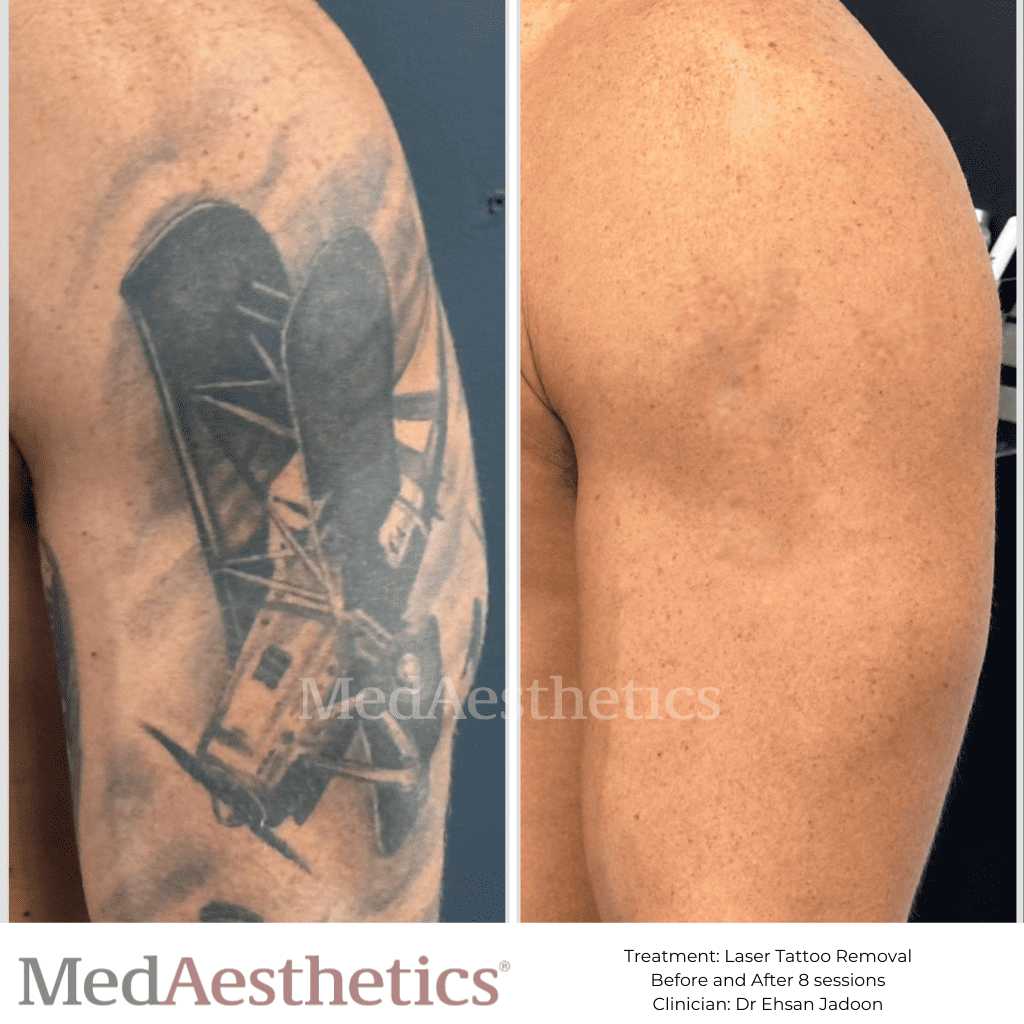 Tattoo Removal Portsmouth | Laser Tattoo | Changes Clinic
