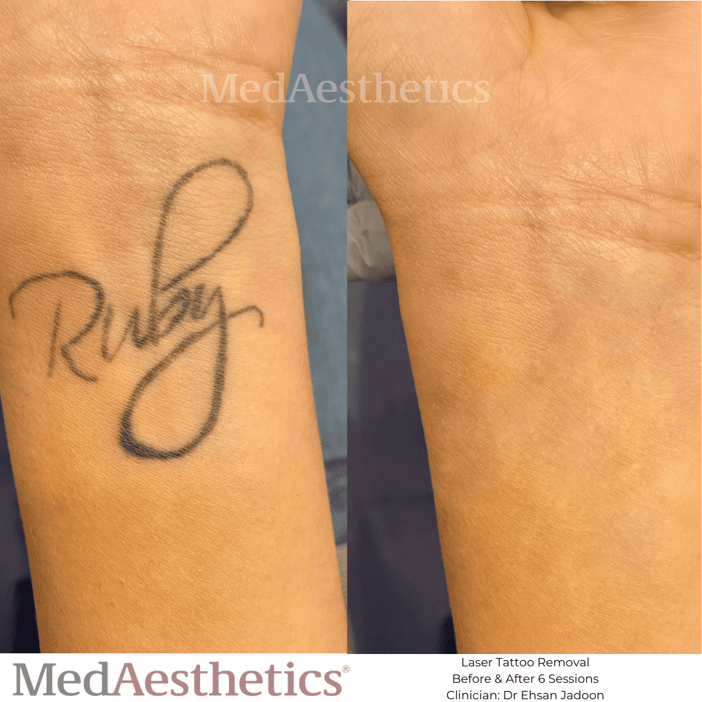 80 off Painless PicoWay Tattoo Removal from Dr Boulos Medical Spa   WagJag