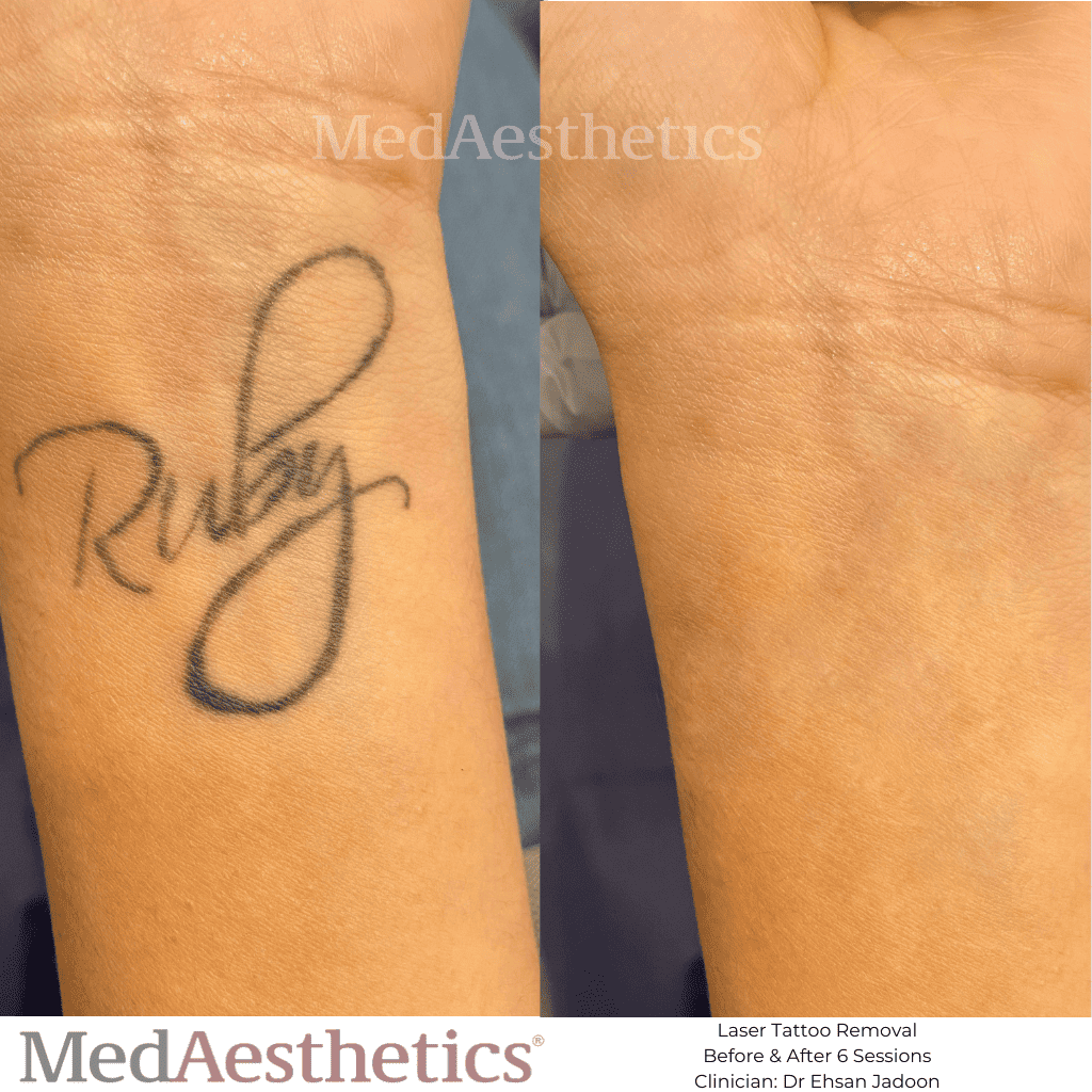 Tattoo Removal in Secunderabad | Renova Skin, Hair & Laser Clinic