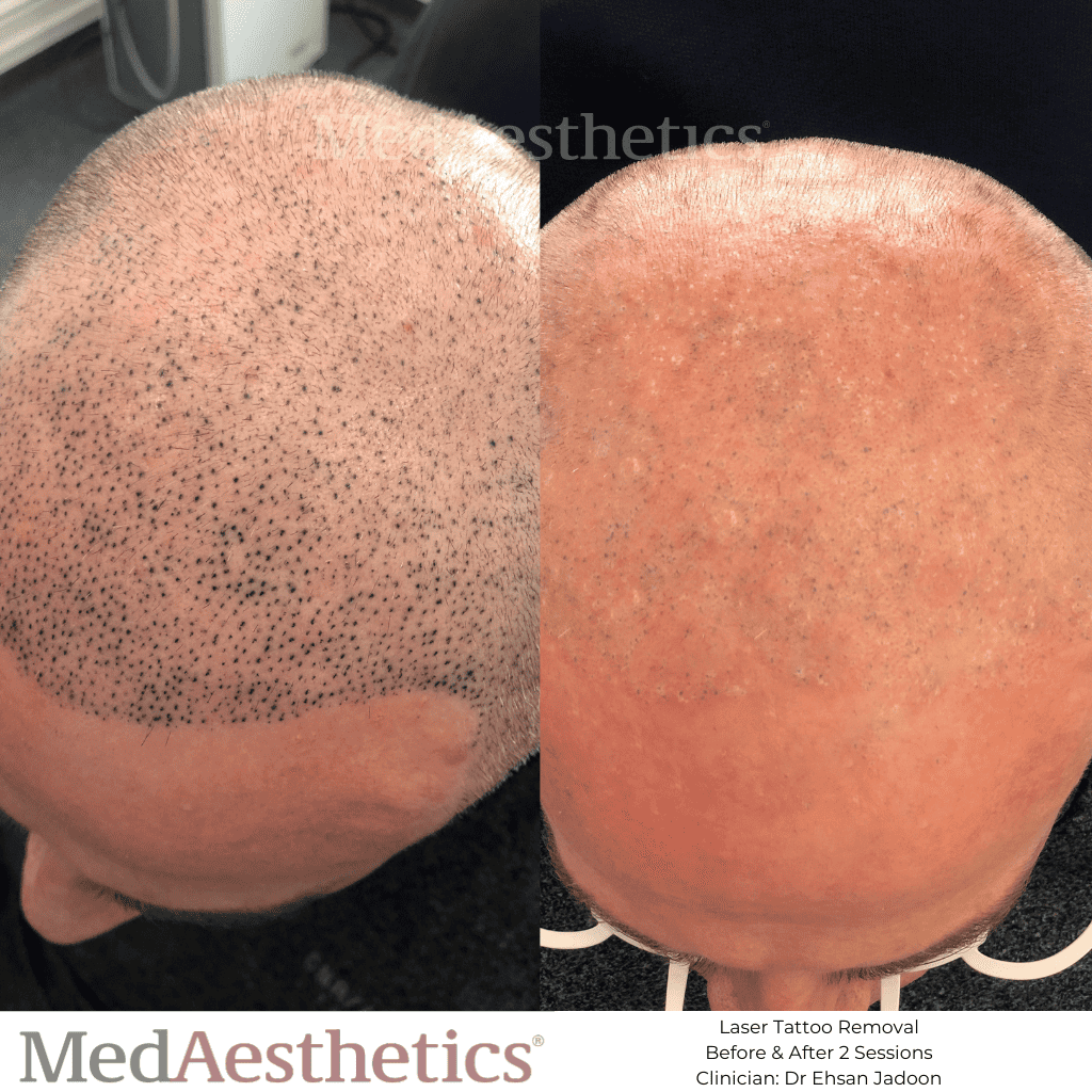 Laser Tattoo Removal Before & After MedAesthetics Perth