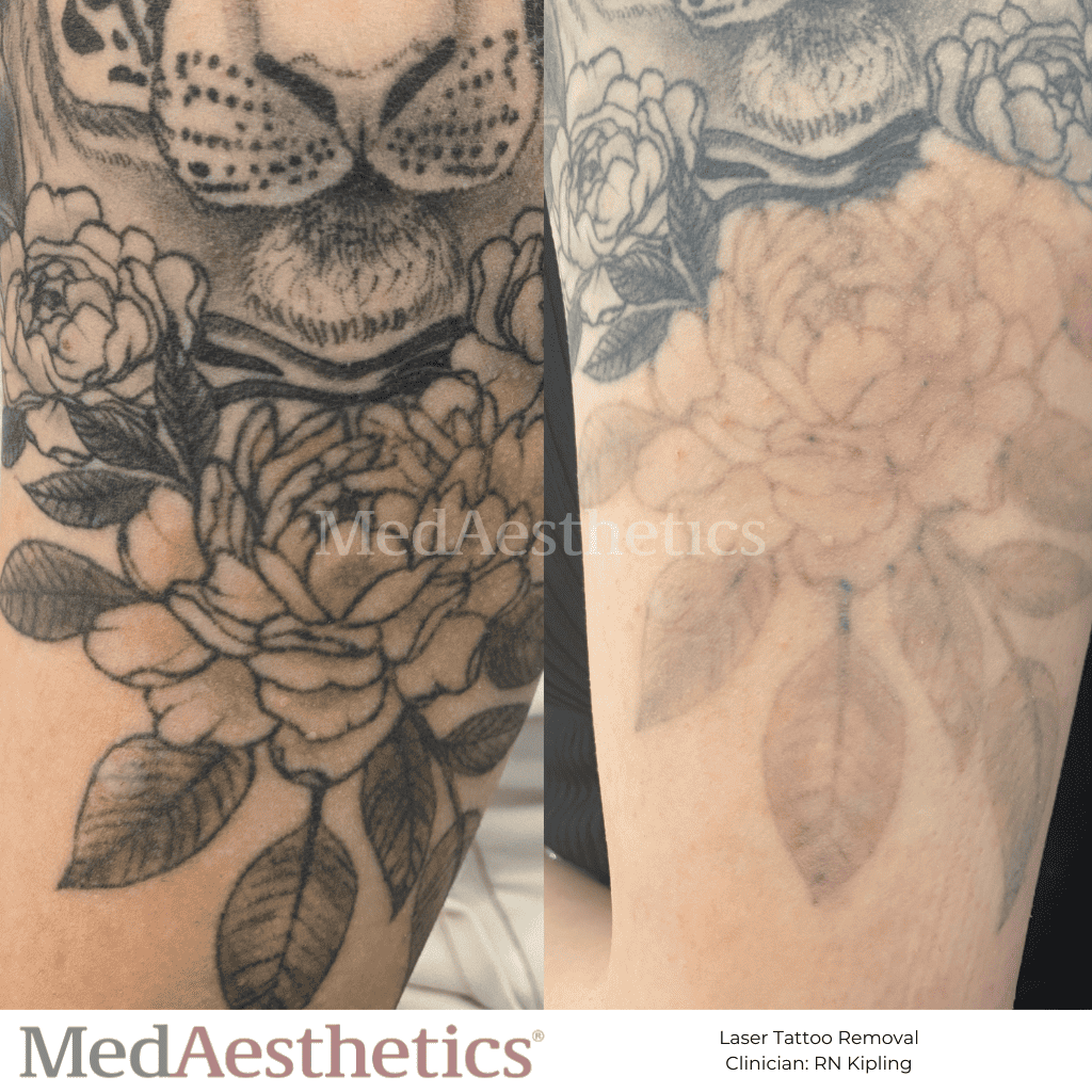 Laser Tattoo Removal Before & After MedAesthetics Perth