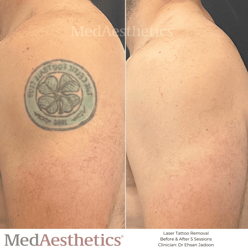 Laser Tattoo Removal vs. Dermabrasion Tattoo Removal | WIFH