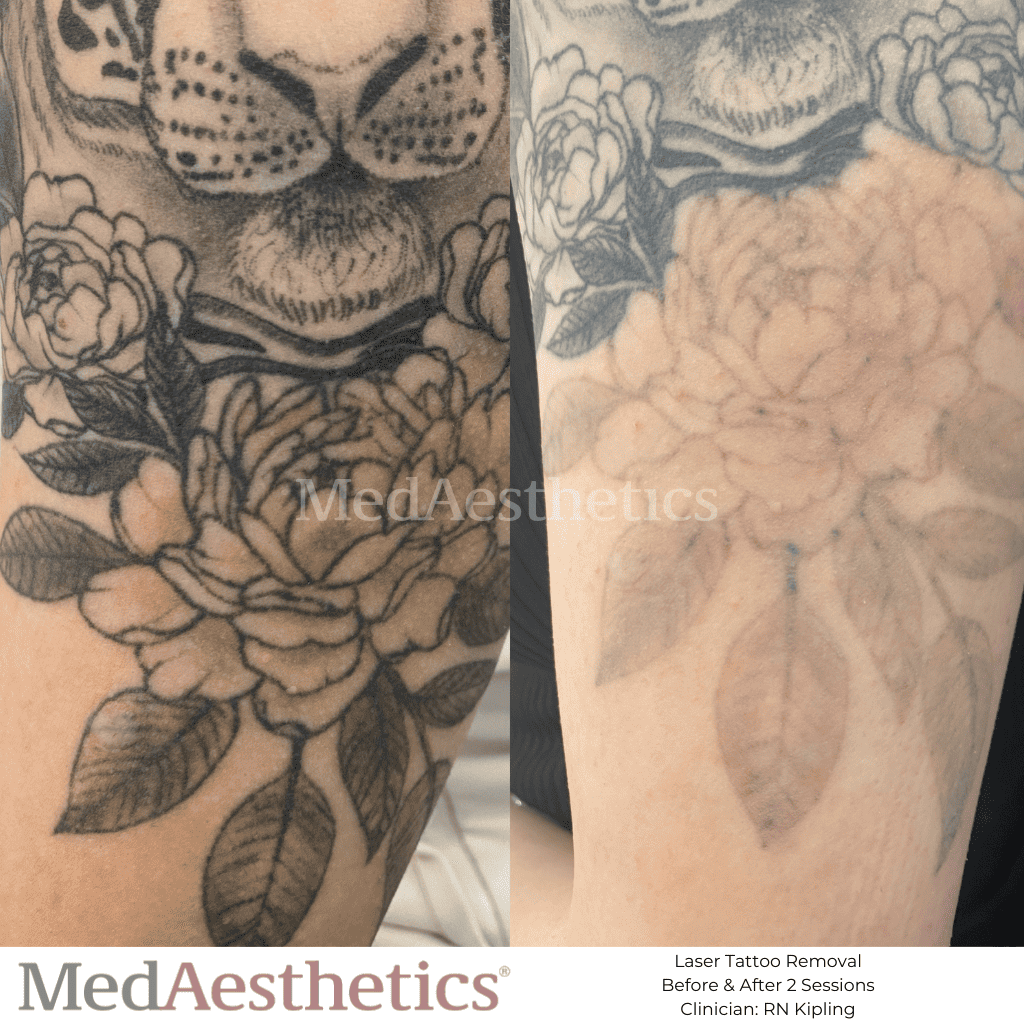 Laser Tattoo Removal: An introductory Guide