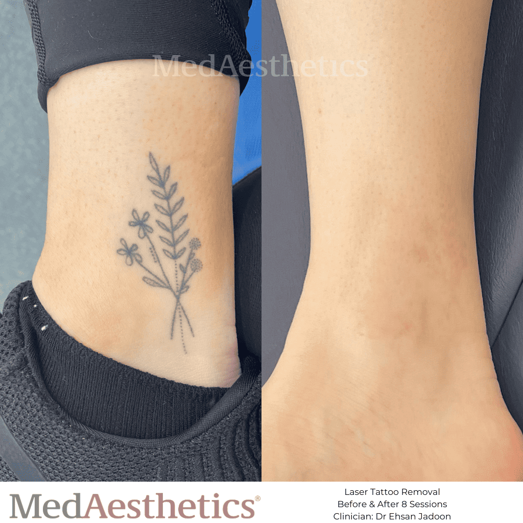 Laser Tattoo Removal Before & After MedAesthetics Perth