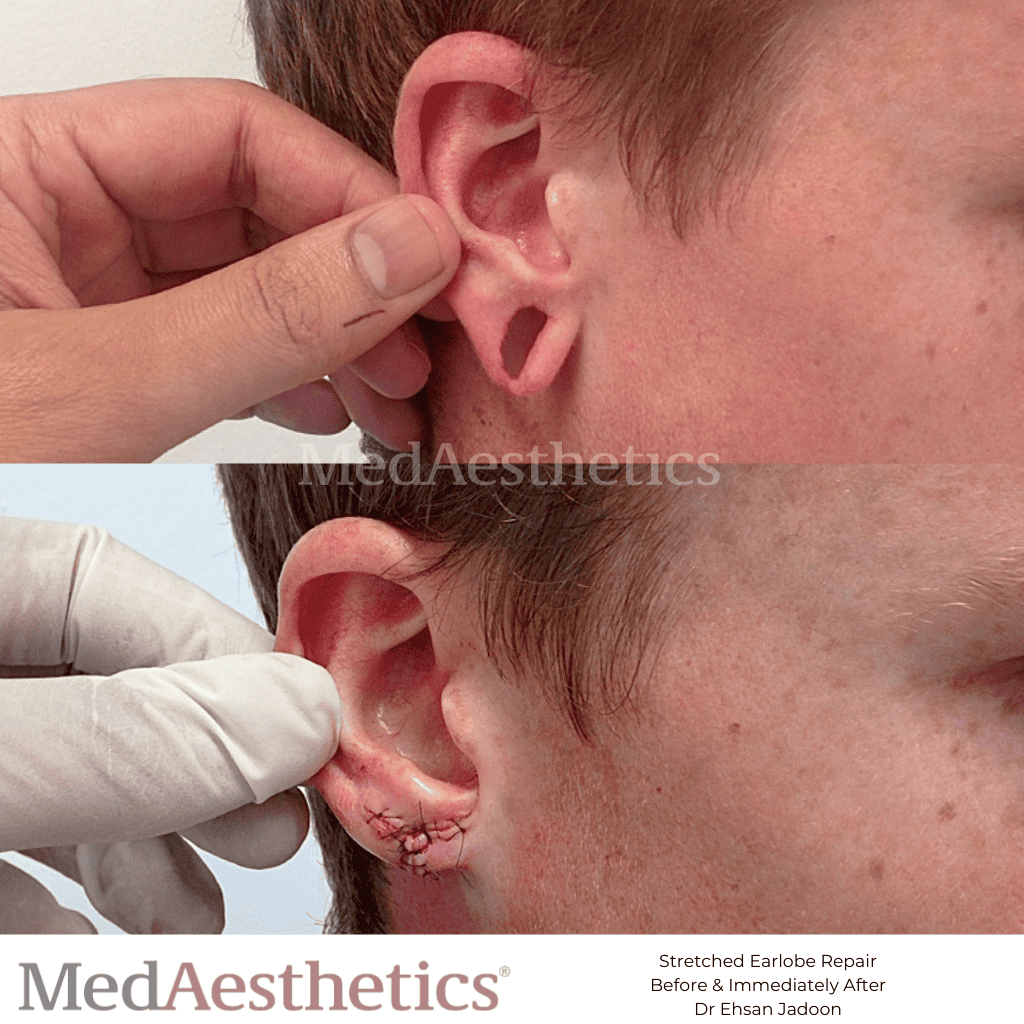 Can Stretched or Torn Earlobes be Repaired? - Dr. Prasad Blog