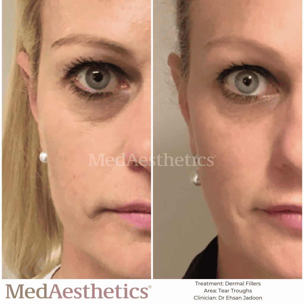 how long does tear trough filler last