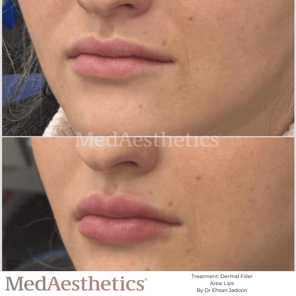 Natural looking Lip Fillers Before & After MedAesthetics Perth